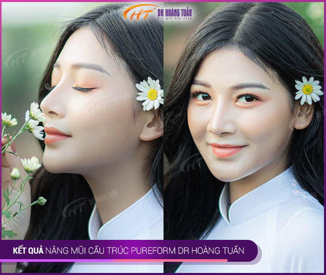 Kết quả làm mũi Pureform tại Thẩm mỹ Hoàng Tuấn